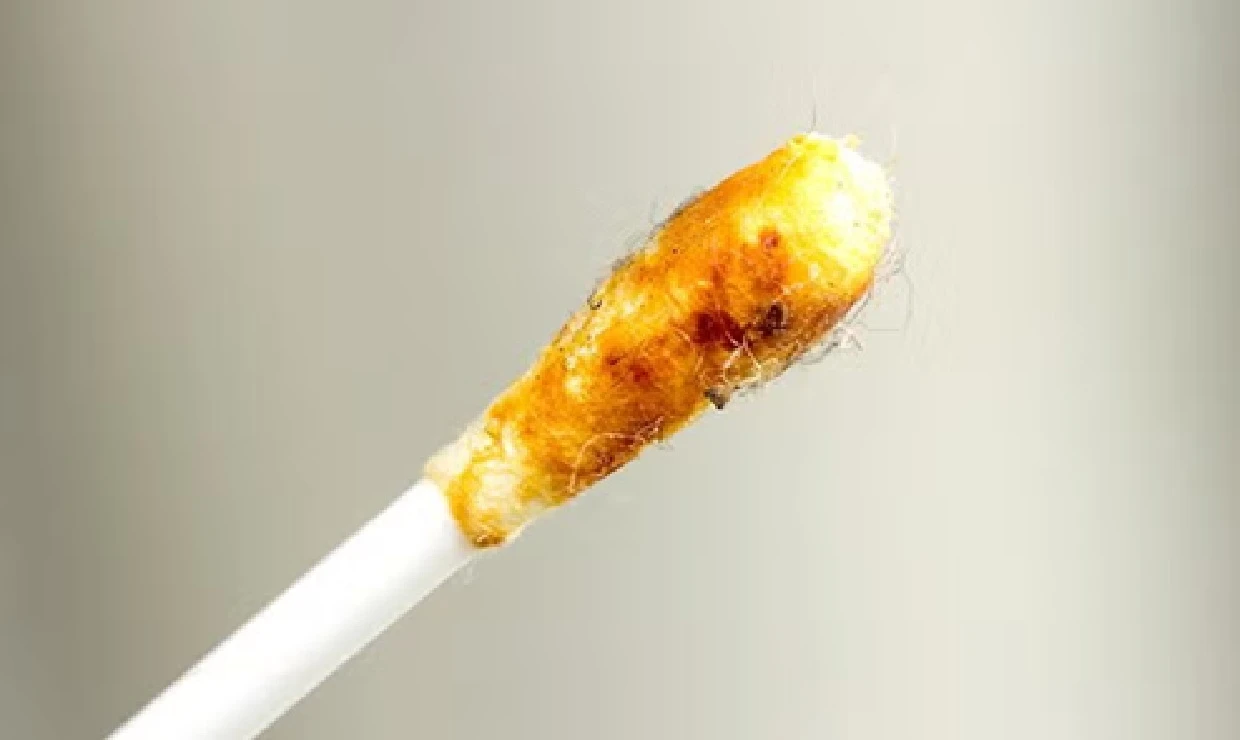 What Your Earwax Color Says About Your Health: Causes, Symptoms, and Crucial Warnings